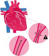 Angina image